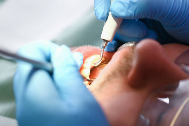 Best Emergency Treatment for Dental Infections or Abscesses in Hayward, CA
