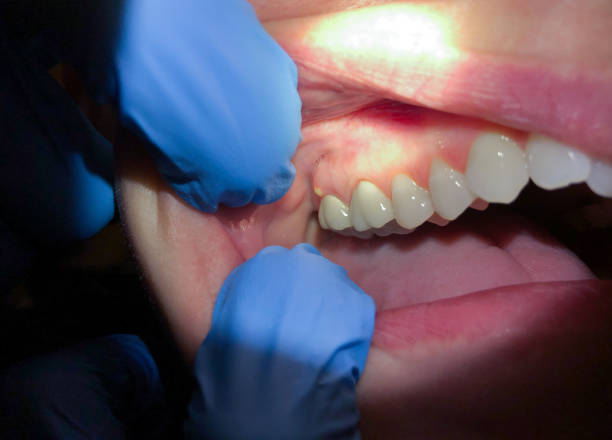 Best Emergency Wisdom Teeth Removal in Hayward, CA